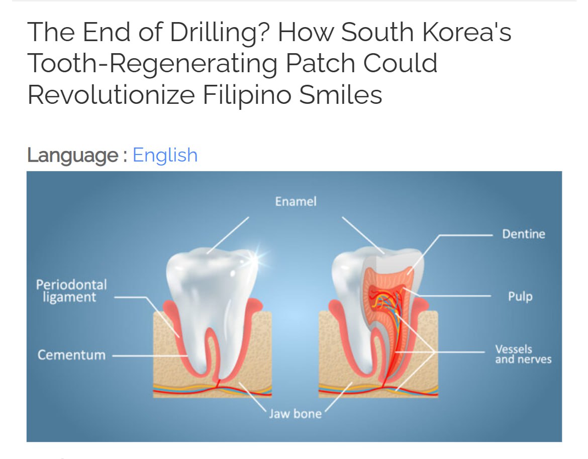 Пластырь для РЕГЕНЕРАЦИИ ЗУБОВ сделали в Корее он позволит вернуть утраченные зубы Пластырь начинён микроиглами которые доставляют препарат tideglusib Препарат стимулирует зубные стволовые клетки к регенерации эмали и формированию новых зубных зачатков Пластырь накладывается на десну на 20 минут в день Первые доклинические испытания провели на животных эмаль восстановилась без операции Ожидаемая цена 300 за зуб а в массовое лечение пойдёт после 2026 года Больше никаких искусственных зубов PushEnter