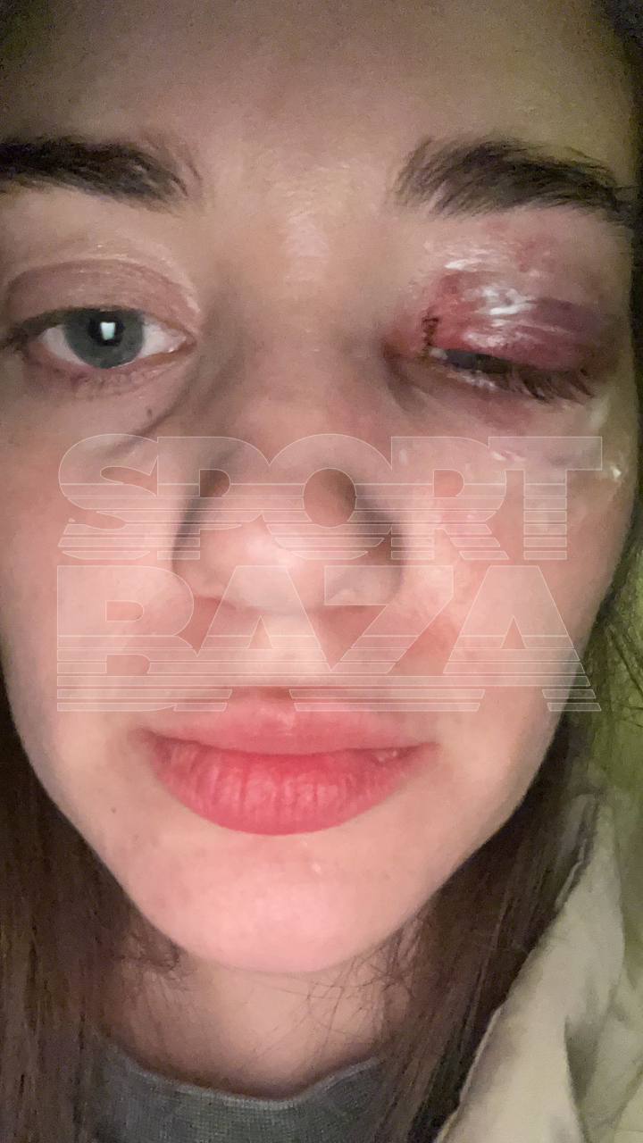 Бронзового призёра чемпионата России по самбо Алексея Гончарова обвинили в избиении сотрудницы ночного клуба в Калининграде. Так он отреагировал на просьбу оплатить счёт. По данным Sport Baza, в ночь на 8 мая трое мужчин отдыхали в ночном клубе «Эйфория». По словам сотрудников заведения, одним из отдыхавших был 38-летний Гончаров. Компания внесла депозит за стол в размере 7500 рублей и села за столик. Когда пришло время расплачиваться, выяснилось, что мужчины съели и выпили на 16 000 рублей. Посмотрев на счёт, Гончаров с друзьями просто встали и пошли к выходу. Когда сотрудница заведения, 26-летняя Мария, попросила их оплатить недостающую сумму, гости заведения заявили, что уже внесли депозит и ничего больше платить не будут. Мужчины уже зашли в лифт, но Мария не давала им уехать. В итоге один из мужчин решил разобраться с девушкой своими методами: он просто сильно ударил её по лицу. После этого компания удалилась. Другие сотрудники заведения вызвали Маше скорую и полицию. Девушку госпитализировали в больницу, где ей диагностировали два перелома в районе левого глаза. Во время просмотра камер наблюдения, один из сотрудников узнал в нападавшем Гончарова. Сейчас полицейские ищут подозреваемого. При этом сотрудники заведения опасаются, что Гончаров сможет уйти от наказания благодаря своим связям. Подписывайтесь, это Sport Baza