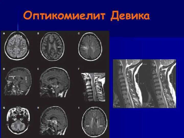 В России зарегистрирован инновационный препарат для лечения оптиконевромиелита болезнь Девика сообщили ТАСС в пресс службе компании Biocad Болезнь Девика аутоиммунное заболевание центральной нервной системы при котором поражаются зрительный нерв и спинной мозг Безопасность и эффективность препарата были изучены в ходе клинического исследования участие в котором приняли пациенты в возрасте от 18 до 76 лет из России и Белоруссии