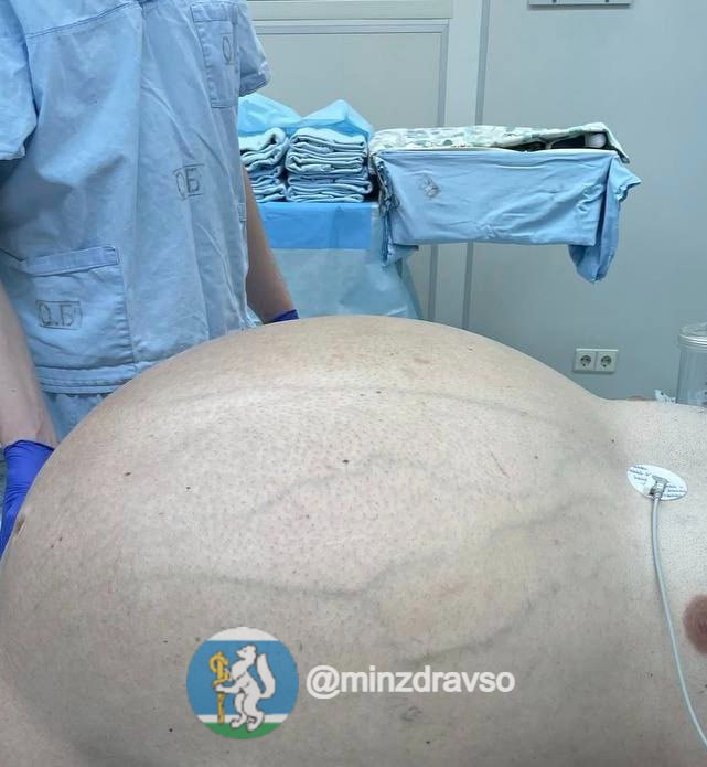 Опухоль весом более 60 кг удалили у мужчины свердловские врачи он ходил с ней более 20 лет Животик у меня стал расти в 33 года до 50 лет он мне не мешал я с ним тихонько бегал сила была в работе не мешал После 50 лет стало тяжело рассказал пациент Онкологи медучреждения отметили что не сталкивались с таким за 30 летнюю практику а операционная бригада из восьми человек удаляла ее почти восемь часов Подписаться на РИА Новости