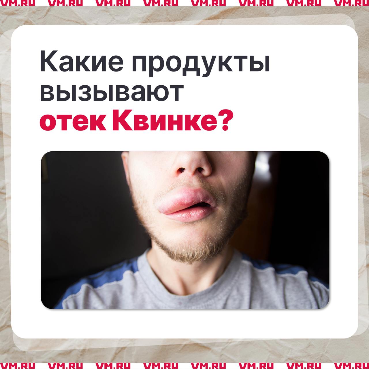 Старший сын Никаса Сафронова Дмитрий едва не погиб из-за отека Квинке Через 15 минут после того, как 40-летний Дмитрий выпил протеиновый коктейль, он начал задыхаться, стал бледным и едва не потерял сознание. Мужчину экстренно госпитализировали. Острое ангионевротическое состояние возникло из-за коктейля с содержанием сои. По словам аллерголога-иммунолога Владимира Болибока, ангионевротический отек может возникнуть и на «псевдоаллерген» — раздражающий фактор, который не вызывает иммунологическую реакцию, но может провоцировать симптомы. Чаще всего к таким раздражителям относятся продукты питания, в которых содержится растительный белок. К ним относятся бобовые: соя; фасоль; нут; арахис. Чтобы при отеке Квинке оказать человеку первую помощь, нужно приложить что-то холодное на ту область, на которой он возник, а также дать антигистаминные лекарства. Подписаться на «Вечернюю Москву»