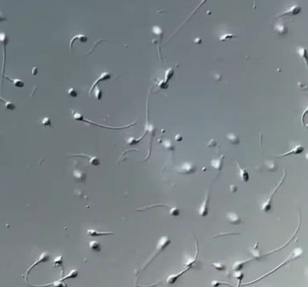 В Европе выявили донора спермы с редкой мутацией он стал отцом почти 200 детей многие из которых рискуют столкнуться с раком В 2005 году датский студент пытаясь подработать регулярно сдавал сперму которую затем использовали для зачатия 197 детей в 67 клиниках по всему Евросоюзу Позже выяснилось что у мужчины была редкая мутация гена TP53 существенно повышающая риск развития онкологии до 90 особенно в раннем возрасте Сам донор не знал о патологии а проведенные скрининги ничего не обнаружили Проблема вскрылась когда у детей зачатых с использованием его биоматериала начали диагностировать лейкемию и неходжкинскую лимфому Мутацию уже нашли у 23 из 67 проверенных детей десять из них уже столкнулись с онкологическими заболеваниями Некоторые скончались в младенческом возрасте Это крайне тяжелый диагноз для всей семьи и жить с таким риском очень непросто Это по настоящему разрушает отметила генетик онколог Клэр Тернбулл Датский банк спермы предоставивший биоматериал выразил глубокие соболезнования семьям Канал n w order