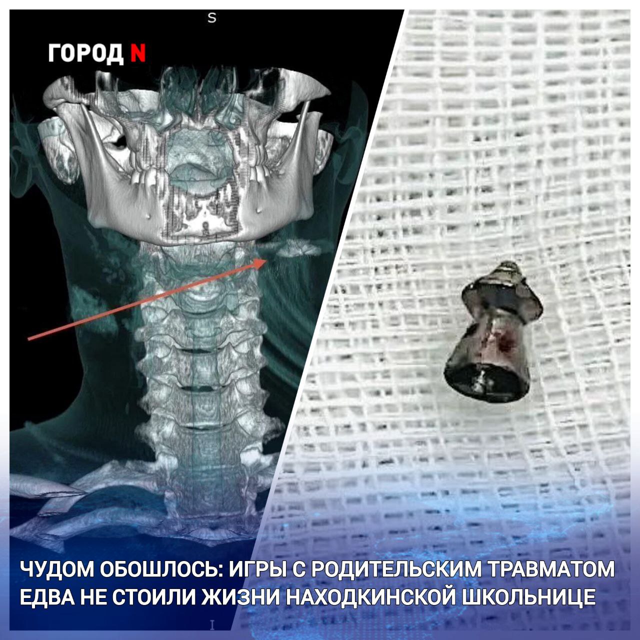 13 летняя школьница из Находки чуть не погибла случайно выстрелив себе в шею при неосторожном обращении с пневматическим оружием принадлежащим ее родителям Ребенка доставили из Находки во Владивосток специалисты Центра медицины катастроф У девочки было тяжелое ранение Пуля попала в шею повредила гортань и остановилась в проекции сосудисто нервного пучка шеи Врачи краевой клинической больницы 2 прооперировали девочку Операция прошла успешно Пулю извлекли не задев яремную вену Разрез от хирургического вмешательства составил всего 2 5 см ребенку наложили косметические швы Сейчас врачи оценивают состояние ребенка как удовлетворительное и готовят к выписке