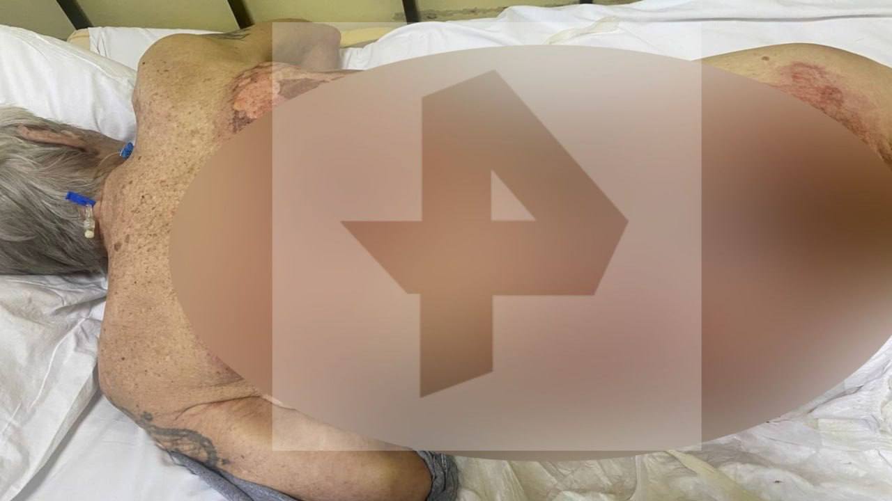 Пожилой обнинец который принимая ванну обварился кипятком скончался в КБ8 Трагедия случилась на Энгельса 36 еще в конце декабря 75 летний пенсионер не смог выключить горячий кран из которого полился кипяток Пожилой человек не сумел быстро выбраться из ванны и сильно обварился Его доставили в больницу но несмотря на все усилия медиков спустя почти две недели человек скончался Очевидно виновные должны понести ответственность Кто это будет ответственные лица управляющей компании которая не отрегулировала подачу горячей воды или кто то иной должно решить следствие Фото Рен ТВ Не грузит телеграм Подписывайся на наш канал в MAX