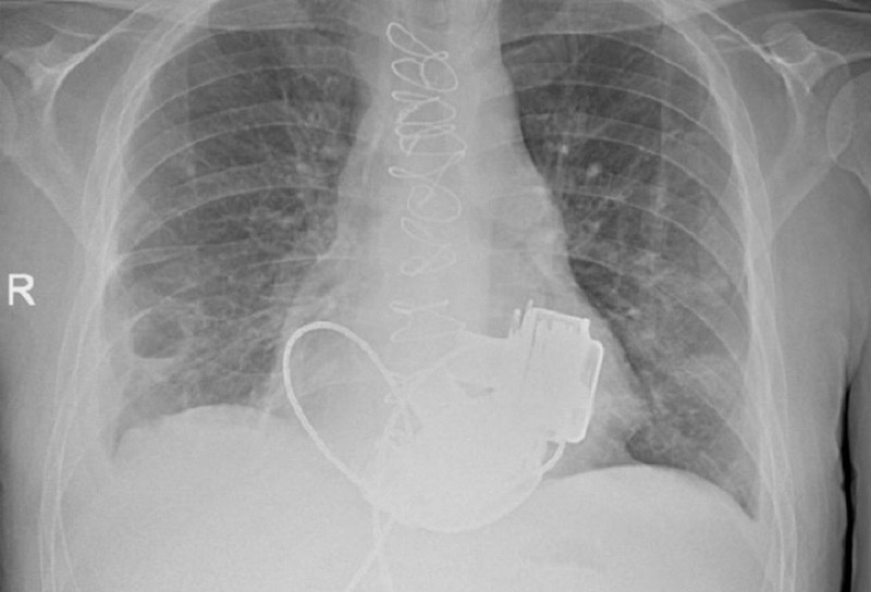 Пациента без пульса выпишут из больницы в Петербурге Уникальный пациент которому впервые в России имплантировали сразу два искусственных желудочка сердца готовится к выписке из Мариинской больницы в Санкт Петербурге В Мариинской больнице готовится к выписке уникальный пациент который с недавних пор живет без пульса В конце ноября 2025 года ему впервые в России имплантировали сразу два искусственных желудочка сердца левое и правое рассказали в комитете здравоохранения города Операцию провели в конце ноября 2025 года 36 летнего петербуржца экстренно госпитализировали с тяжелейшими диагнозами кардиомиопатией и терминальной сердечной недостаточностью По словам врачей функциональные показатели работы сердца были критическими и находились на уровне характерном для мертвого человека Решение о проведении сложнейшего вмешательства принял главный врач Мариинской больницы Игорь Реутский Операция длилась около четырех часов Самым трудным этапом стало согласование и синхронизация работы двух искусственных желудочков Сейчас состояние пациента стабилизировано Он проходит завершающий этап реабилитации и готовится к выписке Фото пресс служба комитета по здравоохранению Петербурга   Подпишитесь на ivbg ru Ivbg в Max