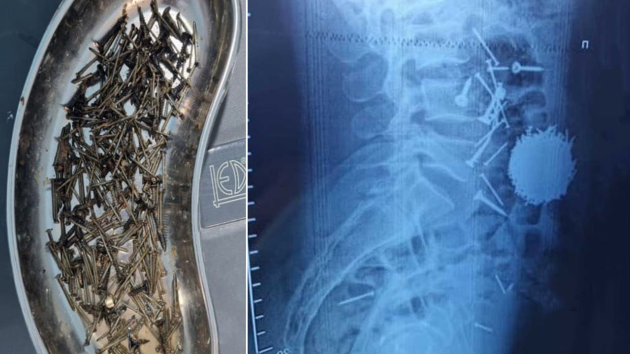 В Самарканде врачи извлекли из пациента почти 200 граммов гвоздей и саморезов Как сообщили медики мужчина проглотил металлические предметы на фоне сильного стресса Ему своевременно оказали медицинскую помощь Подписаться на канал Узбекистан Online