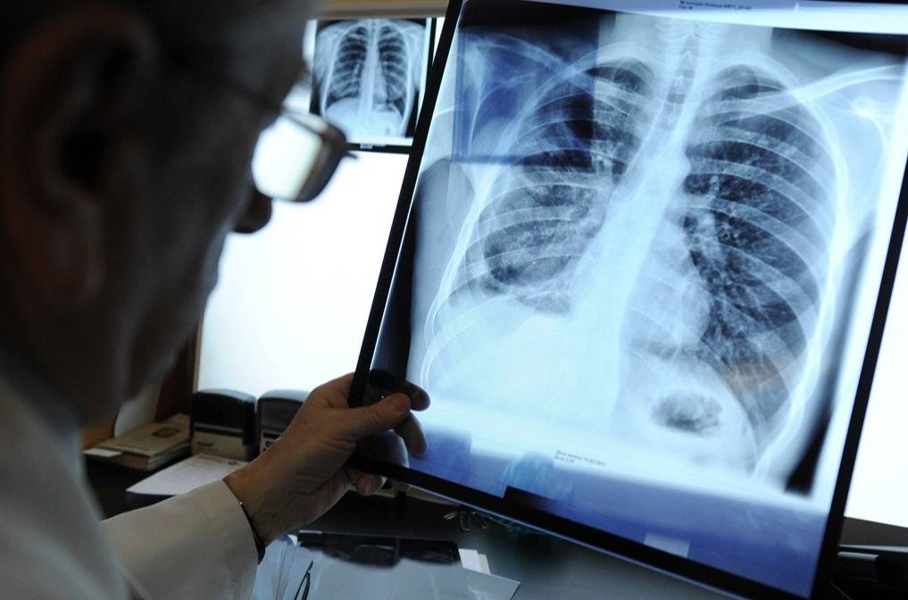 В Спасском округе Приморья у двух школьников выявили туберкулёз У двух учеников школы в селе Чкаловское Спасского округа Приморского края подтвердили заболевание туберкулёзом что вызвало оперативную реакцию властей Информация всплыла после публикации в соцсетях после чего прокуратура начала проверку а специалисты Роспотребнадзора выехали на место для установления контактных лиц и оценки эпидемиологической ситуации Расследование продлится все выходные включая санитарную обработку помещений школы вероятно речь идёт о средней школе 7 или начальной школе сад 24 Это не первый случай в регионе ранее туберкулёз нашли у педагога во Владивостоке и у двоих школьников в Дальнегорске РОДИТЕЛИ ПРИМОРЬЯ