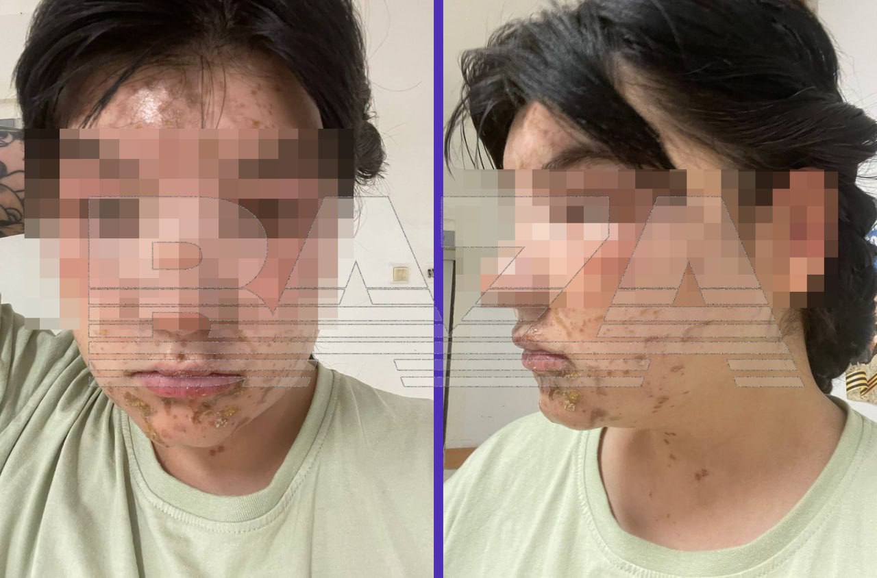 Сотруднице, заменявшей лаборанта на сельхозпредприятии в Ленобласти, прыснула серная кислота в лицо. Вот что бывает, когда сотрудникам дают слишком много задач. Девушка работает бригадиром на СПК «Кобраловский» и обычно не занимается химпроцедурами, но недавно один из лаборантов ушёл в отпуск, и сотрудников предприятия попросили поработать за него. 15 июля девушка проводила анализ молока и нажала на дозатор ёмкости, в которой находился раствор серной кислоты. Проблема была в том, что носик дозатора был закрыт, — кислота под давлением прыснула ей на лицо. На работу тут же вызвали скорую, девушку доставили в реанимацию, затем перевели в отделение хирургической травматологии. Впереди — восстановление и надежды, что следов на лице не останется. Подписывайтесь, это Baza