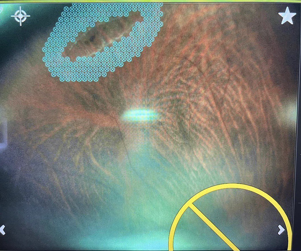 В Воронеже подростку с аллергией на анестетики смогли безболезненно вылечить сетчатку глаза В Воронежскую областную офтальмологическую больницу обратился 16 летний житель Белгородской области с диагнозом периферическая витреохориоретинальная дегенерация сетчатки Это состояние при котором на периферии сетчатки возникают слабые места которые при физической нагрузке могут стать причиной разрыва и отслойки привести к потере зрения Подросток при этом профессионально занимался спортом что является абсолютным противопоказанием при таком заболевании Кроме того у юноши аллергия на обезболивающие препараты Из за этого провести стандартную лазерную операцию и установить контактную линзу было крайне затруднительно Операцию провели бесконтактно при этом подросток не испытал никаких болезненных ощущений В тот же день юноша отправился домой Через две недели он возобновил тренировки без риска для здоровья Подписывайтесь на канал РИА Воронеж в Max