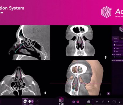 Внедрение ИИ в медицинских устройствах связали с ростом инцидентов с тяжелыми осложнениями Reuters Расследование Reuters показало резкий рост инцидентов после внедрения ИИ в хирургическую навигационную систему для операций на пазухах носа Число зарегистрированных сбоев выросло более чем в 12 раз при этом в исках описаны тяжелые осложнения у пациентов