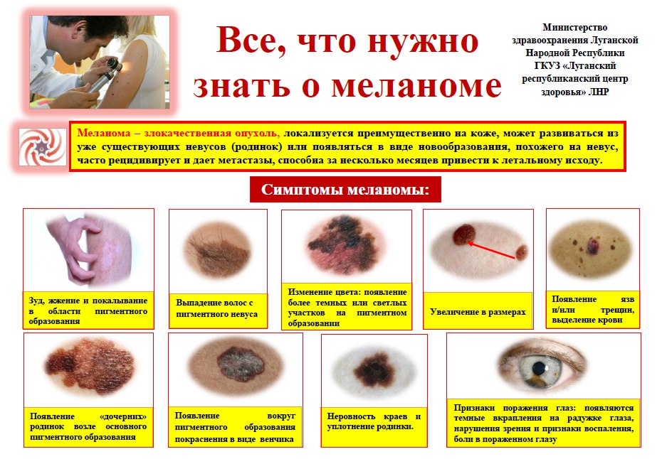 Меланома — это одна из разновидностей рака кожи, которая быстро метастазирует и без лечения может привести к смерти. Риск заболеть меланомой увеличивается с возрастом и достигает пика к 62-65 годам. Чаще всего меланома возникает на коже. Реже она локализуется на сетчатке глаза, слизистой оболочке глаза, слизистой оболочке рта и прямой кишки, на оболочках головного и спинного мозга.Основные факторы риска меланомы: - ультрафиолетовое излучение, т.е. длительное пребывание на солнце, посещение соляриев; - крупная врожденная родинка, занимающая более 5% поверхности кожи на теле; - светлая кожа,склонная к солнечным ожогам и т. д. Меланома в начальной стадии очень похожа на обычную родинку или пигментное пятно, что затрудняет раннюю диагностику.Визуально она не всегда выглядит угрожающе, но в сравнении с другими злокачественными кожными новообразованиями меланома быстрее распространяется через лимфатическую систему и кровоток. Самообследование занимает 5-10 минут, визит к дерматологу происходит один раз в год, и это минимальные усилия,которые могут спасти вашу жизнь. С 19 по 23 мая 2025г. в поликлинике №3 врачом — дерматологом Никитенко А.Ю. будет проводиться целевой профилактический осмотр населения, с целью выявления злокачественных новообразований кожи Помните, что Ваше здоровье в Ваших руках, и никто не позаботиться о нем лучше, чем Вы!