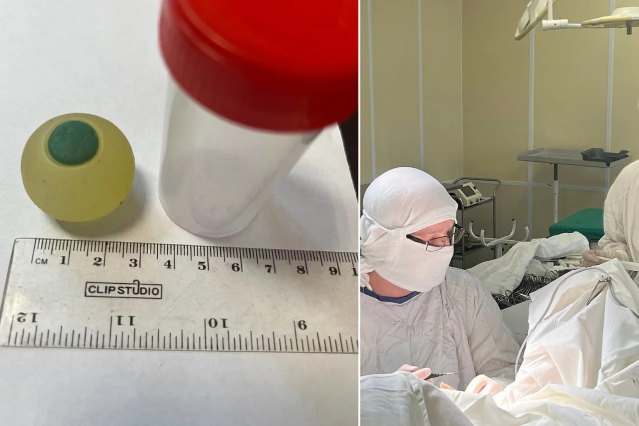 Девятилетний ребенок в Челябинске проглотил глаз от игрушки Мальчика из за болей в животе тошноты и рвоты сначала доставили в инфекционное отделение одной из больниц города где предполагали отравление или вирус Но этот диагноз не подтвердился а сам пациент несмотря на расспросы врачей так и не вспомнил что проглотил из за чего определение проблемы существенно осложнилось Ребенка перевезли в горбольницу 1 Такой случай в моей практике впервые Я вижу непроходимость кишечника и в левом подреберье инородное тело Но нет никаких теней никаких критериев которыми можно было руководствоваться для характеристики этого предмета одно понятно что необходима операция так как предмет еще и перемещается рассказывает заведующий отделением УЗИ диагностики ГКБ 1 Челябинска Светлана Ведерникова Позже уже когда предмет достали из кишечника выяснилось что он путешествовал по организму в течение пяти дней Как рассказала мама пострадавшего они с ребенком вспомнили что он ел шуточные сладости мармеладные глаза Рядом лежал и силиконовый глаз Мальчик же в этот момент отвлекался на телефон и видимо не глядя перепутал его со съедобными и проглотил Симптомы же проявились не сразу поэтому их сперва не связали с этим происшествием Фото ГКБ 1 Челябинска Подписывайтесь на Вести Южный Урал в MAХ