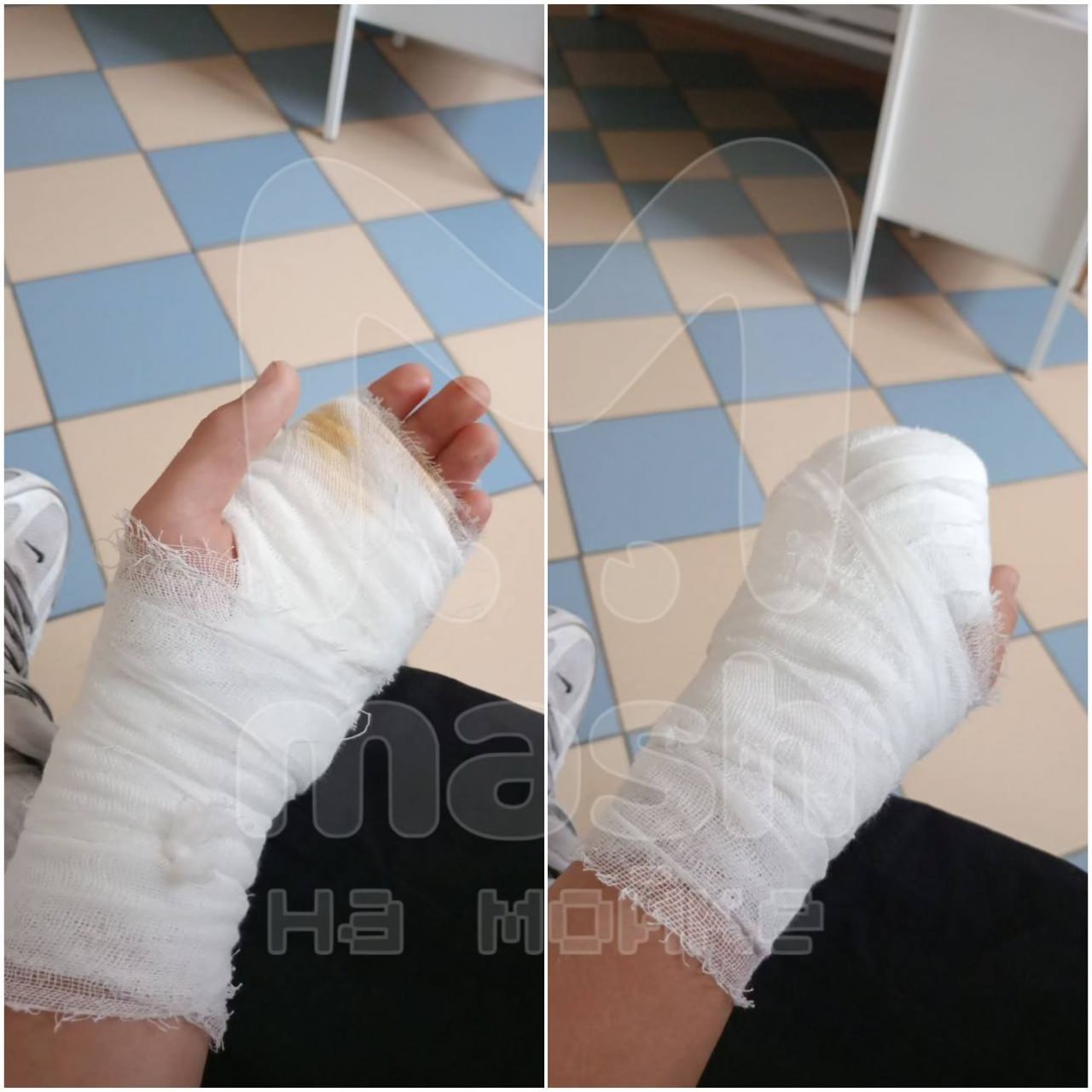 Пострадавшему защитнику девушки на Невском сделали сложную операцию на кисти врачи Педиатрического университета экстренно отправили 17 летнего смельчака с резаными ранами четырёх пальцев и ладони в отделение микрохирургии Спецы объяснили повреждения были крайне близко к нервам и сухожилиям а из за силы удара ножом ситуация сильно усугубилась Однако хирурги оперативно иссекли кожу и сделали пластику тканей аккуратно зашив распоротую агрессором руку После всех манипуляций юноша чувствует себя хорошо говорит чуть побаливает но жить можно Mash на Мойке новости СПб