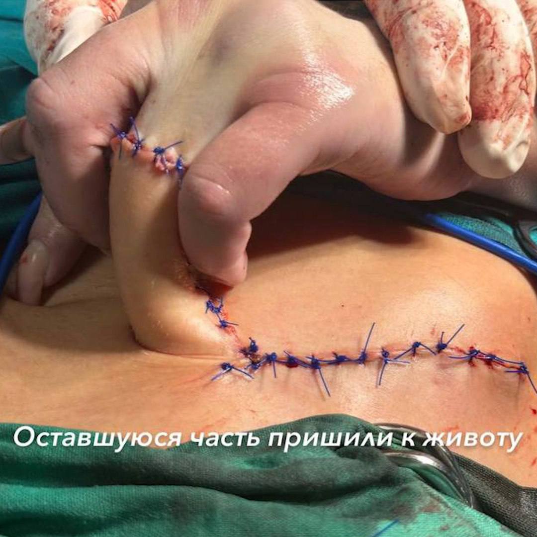 Девушке пришили руку к животу, чтобы вернуть оторванный палец. Она потеряла его из-за обручального кольца. Что?? Зачем? Сейчас расскажем. 24-летняя пациентка РКБ потеряла две фаланги, когда мыла окно и зацепилась за выступ. Хирурги решили восстановить ткани из кожи на животе. Для этого к нему пришили руку — чтобы всё само нарастало. Так девушка проходит четыре недели, а потом травматологи восстановят форму пальчика.