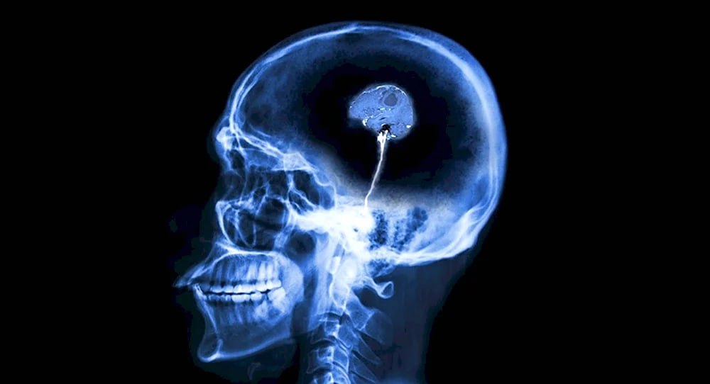 Мужской мозг стареет быстрее женского доказали учёные из Осло Специалисты изучили МРТ сканы более 4 700 людей в возрасте от 17 до 95 лет Результаты показали что у мужчин быстрее уменьшается объём мозга особенно в зонах отвечающих за память и движения В некоторых случаях изменения у мужчин происходят почти вдвое быстрее чем у женщин Несмотря на это болезнь Альцгеймера чаще поражает женщин Исследователи предполагают что дело может быть в гормонах Интересно что процессы старения мозга можно замедлить играя в видеоигры Особенно полезны стратегии экшены и спортивные симуляторы такие как FIFA GTA и Minecraft TechGPTNews