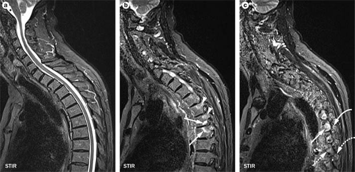 Российские учёные представят препарат для лечения болезни Бехтерева Один из создателей лекарства Сергей Лукьянов ректор Пироговского университета По его словам препарат основан на принципиально новом механизме действия Он уничтожает прицельно специфически те клетки которые вызывают болезнь аутоиммунные лимфоциты Другие препараты обычно подавляют иммунную систему в целом пояснил специалист РИА Новости Ректор вуза добавил что Сенипрутуг относительно редко вводится раз в шесть месяцев или раз в год Подписаться на Говорит Москва Telegram VK MAX