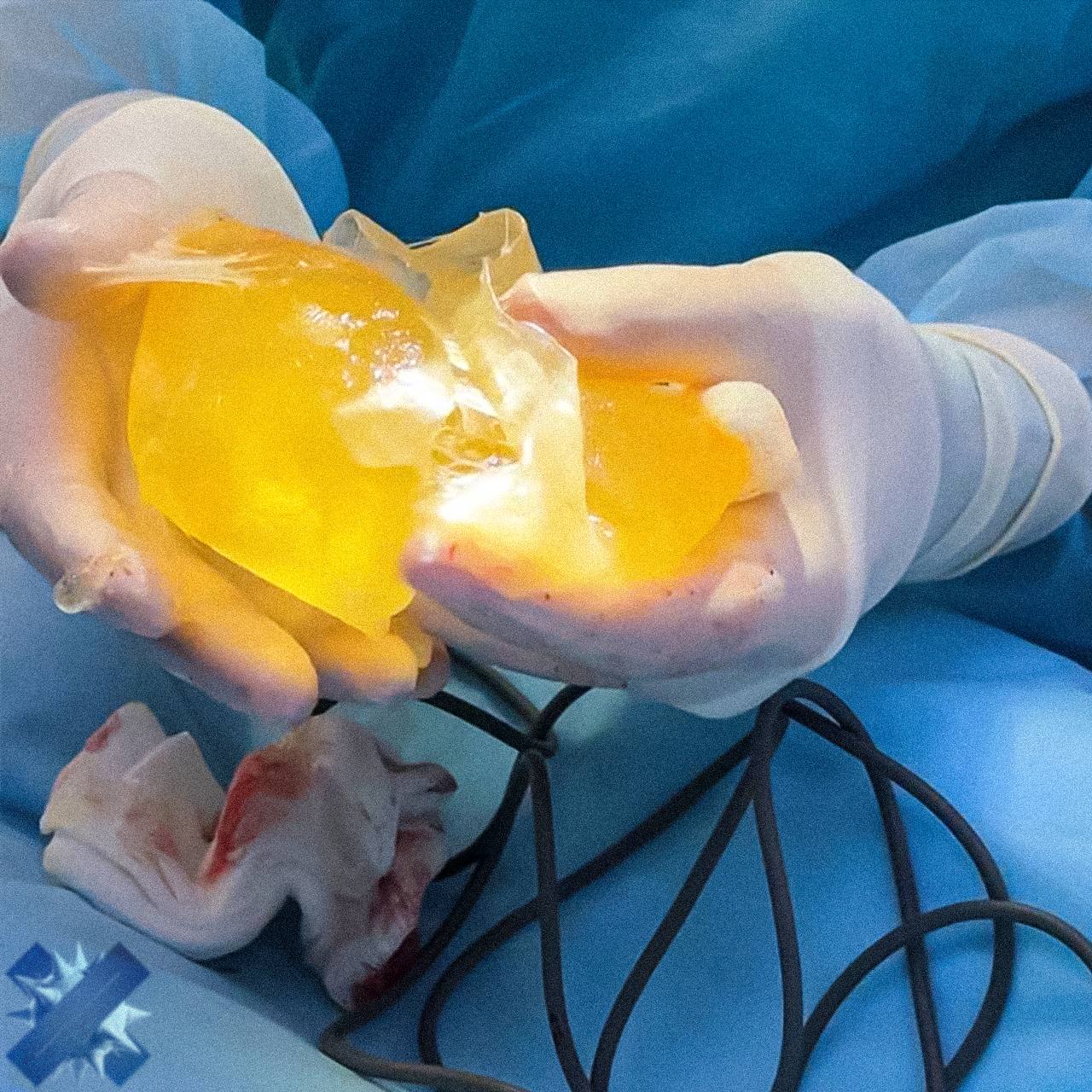 Силиконовая грудь взорвалась у блогерши из Уфы во время тренировки в зале Россиянка решила сэкономить на пластике и сделала операцию у знакомого хирурга в районной больнице за 200 тысяч тихо без документов Импланты продержались 6 лет но на днях в спортзале бедолага почувствовала дискомфорт услышала громкий хлопок В частной клинике назвали случай уникальным обычно импланты рвутся постепенно Хирург уволился из больницы год назад а администрация ничего о случившемся не знает как можно было на это пойти со здоровьем не шутят сама виновата НМШ