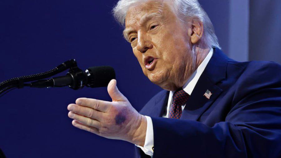 На форуме в Давосе Дональд Трамп был замечен с синяком на руке Президент США рассказал что получил ушиб зацепившись за стол а его слова были подтверждены представителями Белого дома Я просто поранился Нанес немного как его там мази прокомментировал Трамп