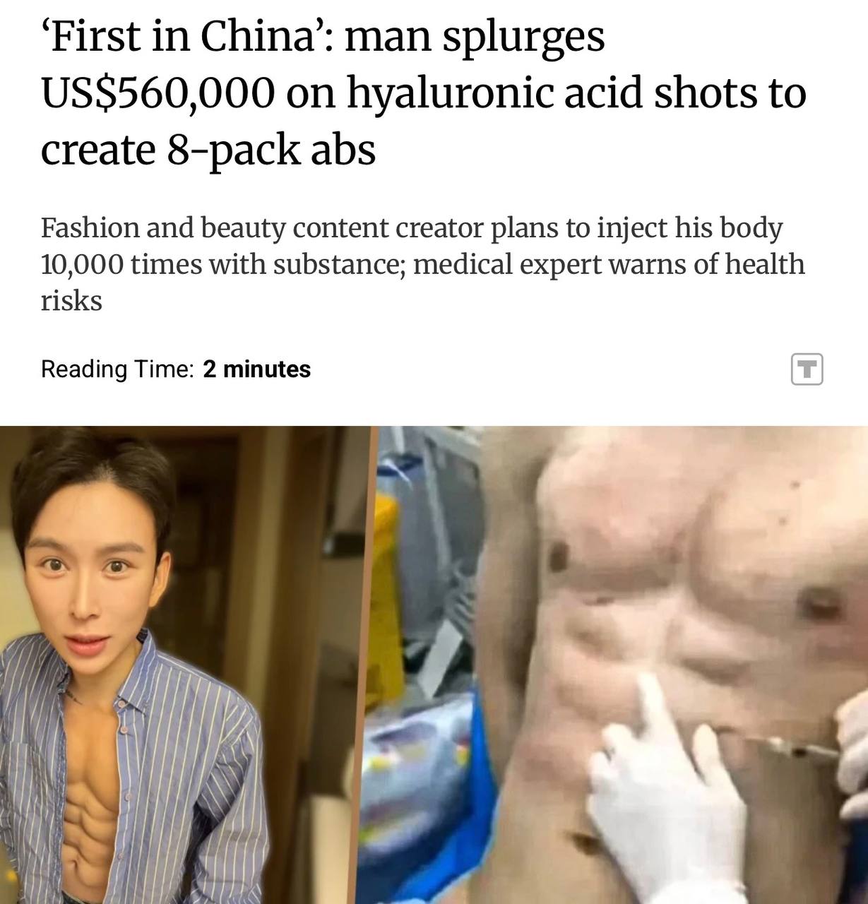 Китаец потратил 45 млн 560 тыс на искусственный пресс из 8 кубиков пишет South China Morning Post По его словам он стал первым человеком в Китае с подобным результатом Мужчина утверждает что 20 его тела состоит из гиалуроновой кислоты и что он планирует сделать еще 10 тыс инъекций уже выполнив около 40 этой цели Однако врачи предупреждают что это может привести к некрозу кожи смещению филлера и атрофии мышц investingcorp