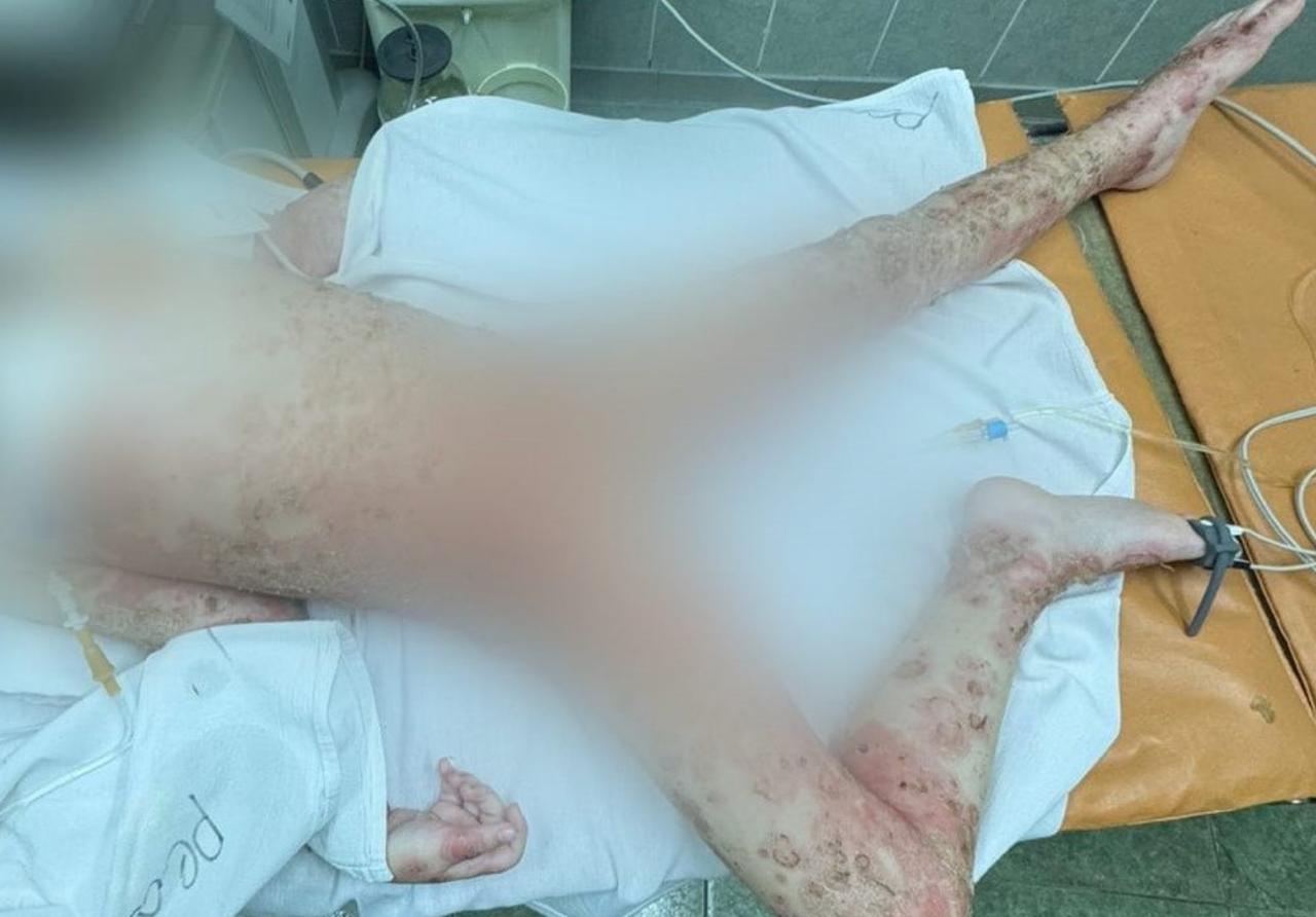 Опасное растение: девочка получила сильнейшие ожоги от борщевика  В Липецкой области четырёхлетняя девочка попала в больницу с ожогами II степени после контакта с борщевиком Сосновского. Пострадало около 70% поверхности тела — ребёнку понадобилась срочная госпитализация.  Инцидент произошёл в селе Нижняя Матренка Добринского района в июле, лечение заняло несколько недель.  — Полное выздоровление наступило через три недели, но на 40% пораженных участков осталась гиперпигментация  изменения цвета кожи , — говорят врачи.  Борщевик продолжает оставаться одной из самых опасных угроз на лугах и обочинах — особенно для детей. При контакте с кожей на солнце он вызывает химические ожоги, порой несовместимые со здоровьем.  Будьте внимательны: не позволяйте детям играть в высокой траве и объясняйте, какие растения опасны.