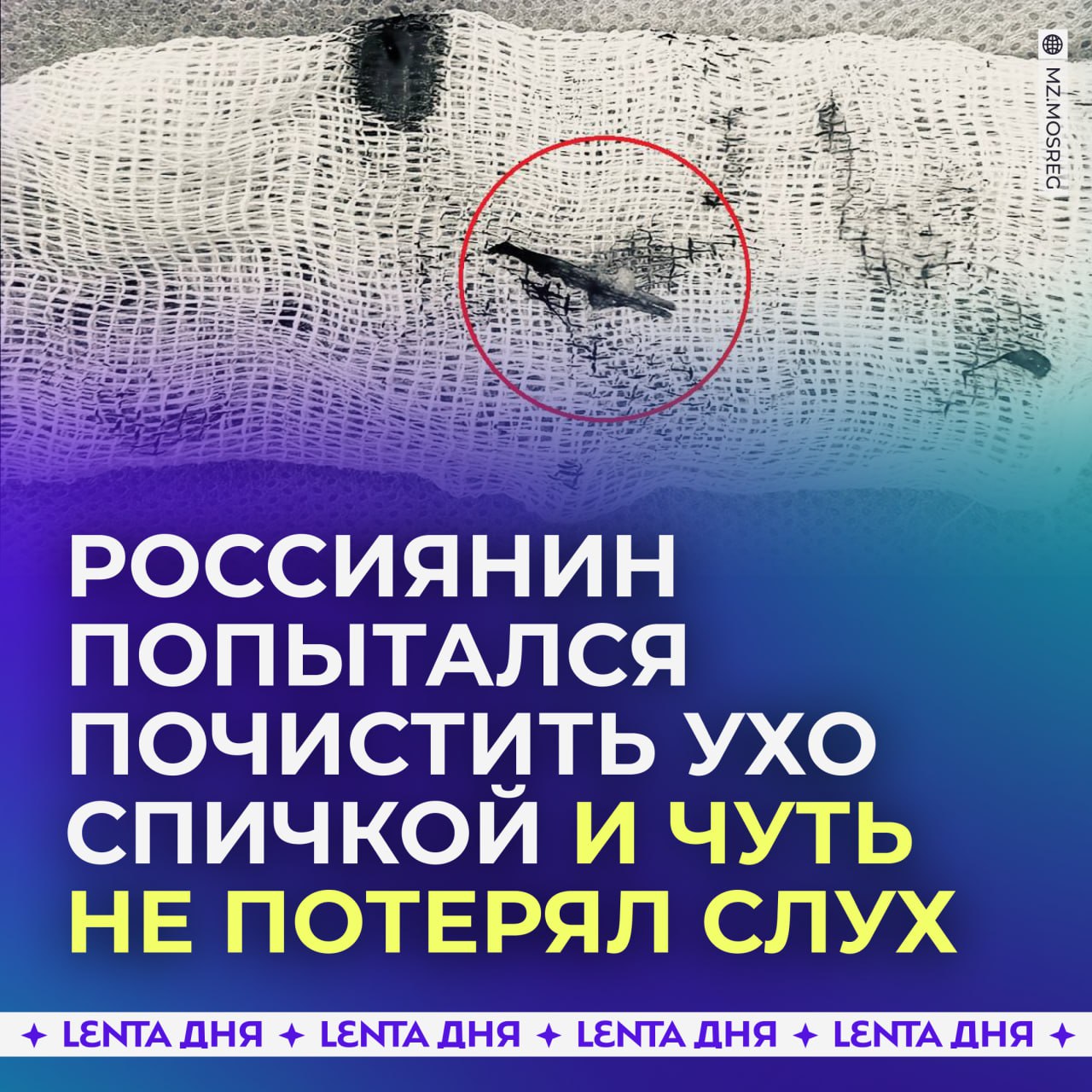 Россиянин чуть не погиб... из-за спички в ухе.  69-летний пенсионер попал в больницу с плохим слухом и гноем в ухе. Выяснилось, что он пытался почистить ухо спичкой, и кусок остался внутри.  Врачи провели операцию, удалив спичку, которая разорвала барабанную перепонку и вызвала воспаление. После операции слух частично восстановили, и пациента выписали домой с обещанием больше не ковыряться в ушах.    — что это за способ такой?   — я тоже так делаю