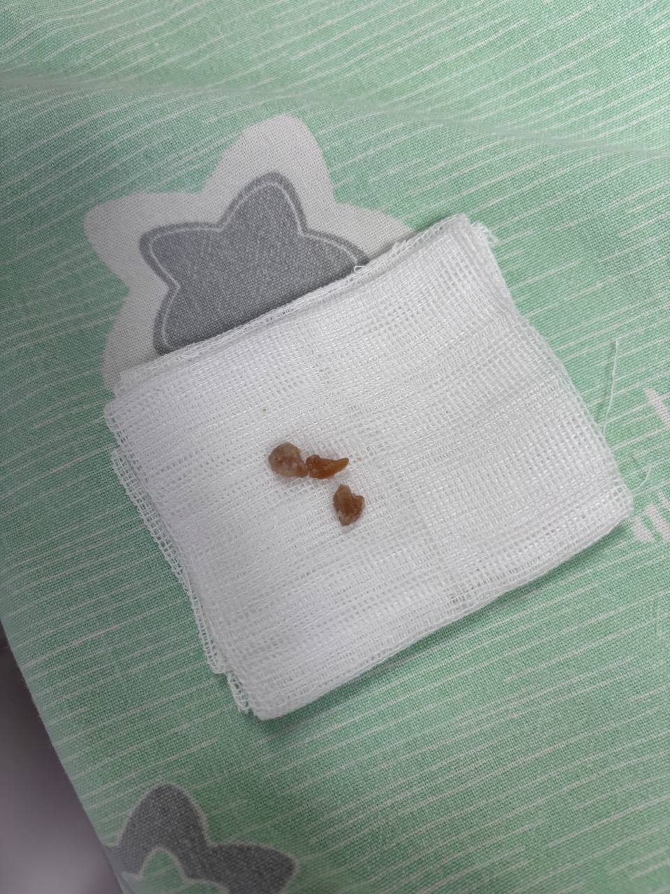 Кусочек арахиса чуть не убил годовалого ребенка в Иркутске Хирурги Иркутской областной детской клинической больницы спасли годовалого ребенка оказавшегося в критическом состоянии из за инородного тела в дыхательных путях кусочка арахиса в сахарной глазури Главврач больницы Юрий Козлов обратился к родителям с настоятельной просьбой об усилении бдительности и исключении опасных предметов из поля зрения маленьких детей Арахис попавший в дыхательные пути ребенка полностью заблокировал правое легкое вызвав тяжелое кислородное голодание и критическое снижение сатурации Экстренная эндоскопическая операция проведенная хирургами позволила извлечь инородное тело и спасти жизнь малышу из тг канала Юрия Козлова irktoday