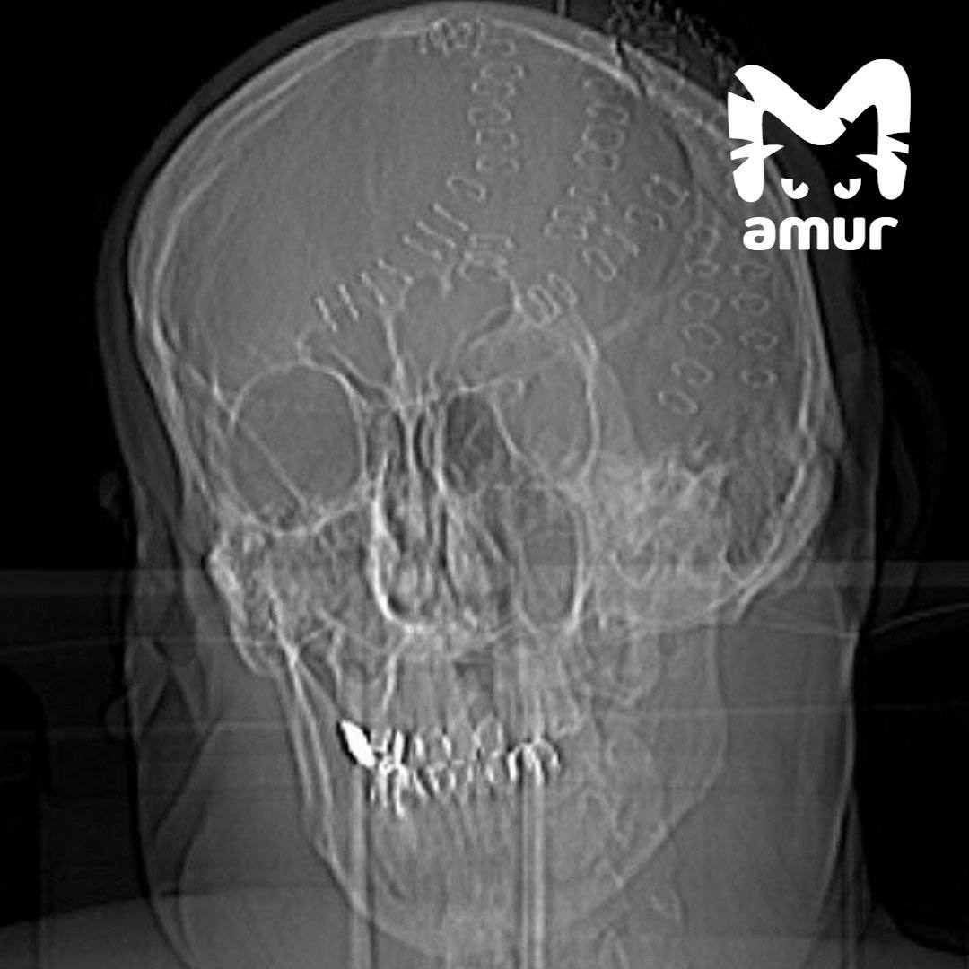 Раздробленный топором череп заново собрали жителю Приморья. 50-летнего мужчину с острова Попова доставили в больницу Владивостока — с кровоизлиянием, ушибом мозга, множественными вдавленными переломами теменных костей и рубленными ранами головы. Состояние было критическим: он впал в шок. Медики провели экстренную сложную операцию — длилось всё несколько часов, пришлось удалить фрагменты черепа. Сейчас пациент стабилен.