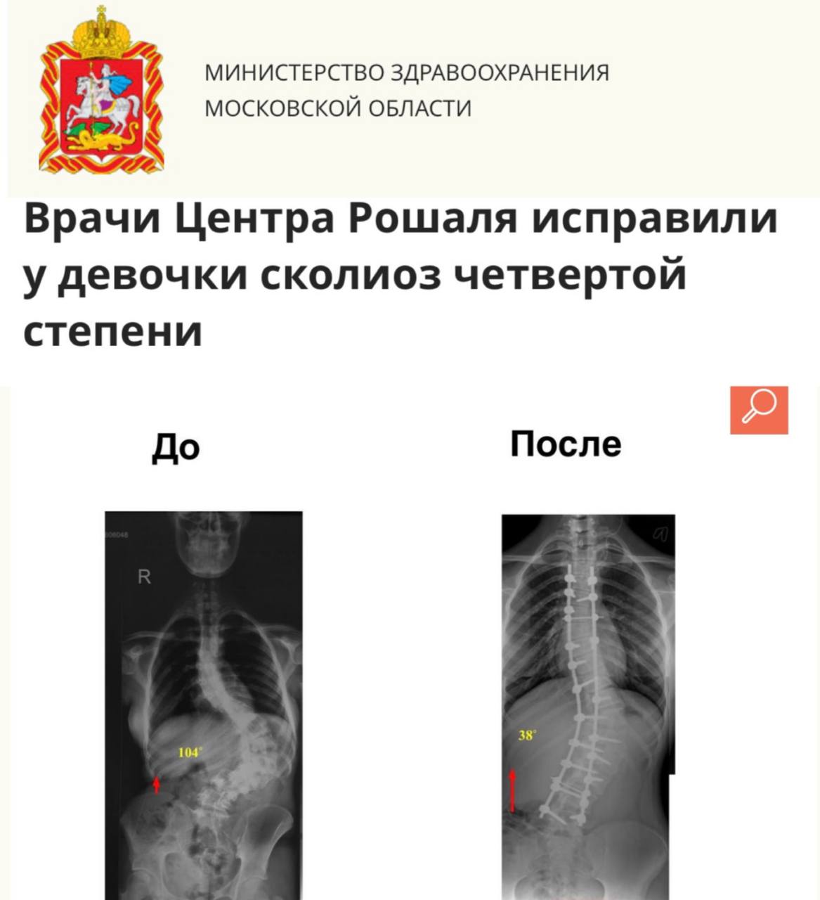 Врачи Центра Рошаля исправили у девочки сколиоз четвертой степени  Сразу после операции 14-летняя девушка, поступившая в Детский клинический центр им. Л. М. Рошаля с жалобами на боли и деформацию спины, выросла на 11 сантиметров.   При поступлении врачи провели комплексное обследование, включая рентген и компьютерную томографию, и диагностировали сколиоз позвоночника четвертой степени. В ходе операции были установлены двадцать титановых винтов, подобранных индивидуально под анатомию пациентки.  Операция прошла успешно, и сейчас девушка проходит курс реабилитации в Детском центре, готовясь к выписке.