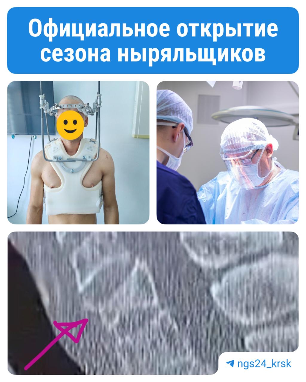 Трое красноярцев с «травмами ныряльщиков» попали в больницу Парни с травмами шейного отдела позвоночника чудом остались живы и даже смогут вернуться к нормальной жизни. Двое получили травмы в бассейне: один поскользнулся и сломал пятый шейный позвонок, другой нырнул и получил сложный перелом первого позвонка. Третий упал с турника — у него поврежден третий шейный позвонок. Врачи провели операции, закрепили позвоночники металлоконструкциями. Сейчас ребята дома, но носят специальные корсеты, а одному — систему гало-фиксации, с которой придется ходить до трёх месяцев. «Им очень повезло — спинной мозг не пострадал, а это часто приводит к трагедиям. Такие травмы нередко заканчиваются параличом или даже смертью, особенно если человек теряет сознание в воде», — рассказал заведующий травматологией Константин Тутынин. Он добавил, что многое зависит от скорости помощи и реабилитации. При нырянии травмы бывают очень серьезными, и восстановление часто бывает лишь частичным. Берегите себя и будьте осторожны!