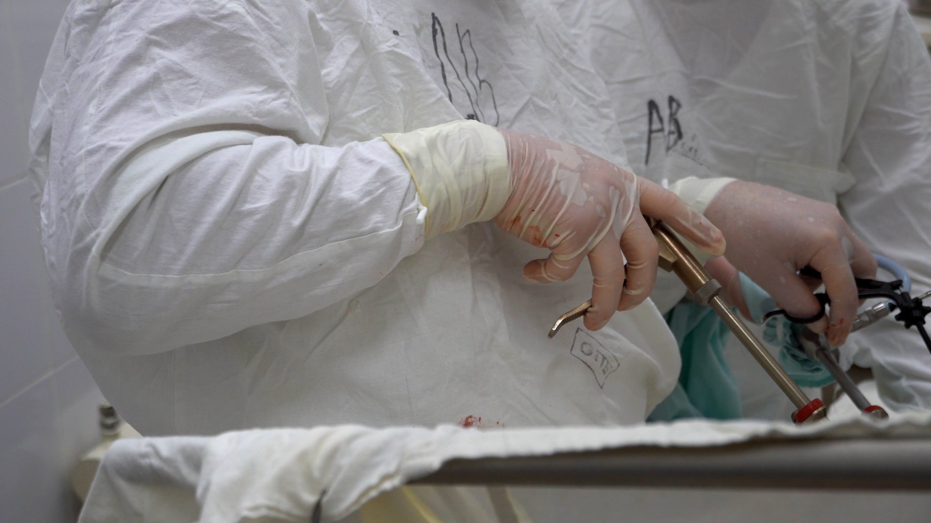 30 килограммовую опухоль яичника удалили у россиянки Москвичка более 15 лет не посещала гинеколога при этом долгое время её беспокоили боли увеличение объема живота одышка слабость чувство распирания Когда она всё же обратилась к врачам выяснилось что на её яичнике выросла гигантская опухоль Окружность живота пациентки достигала 155 см Из за образования грудная клетка женщины была деформирована а внутренние органы сдавлены Медикам удалось удалить образование Также пришлось удалить матку с придатками Диаметр опухоли составил 50 см а вес более 30 кг Образование оказалось незлокачественным признаков поражения соседних органов нет Женщину уже выписали домой сообщает Газета Ru