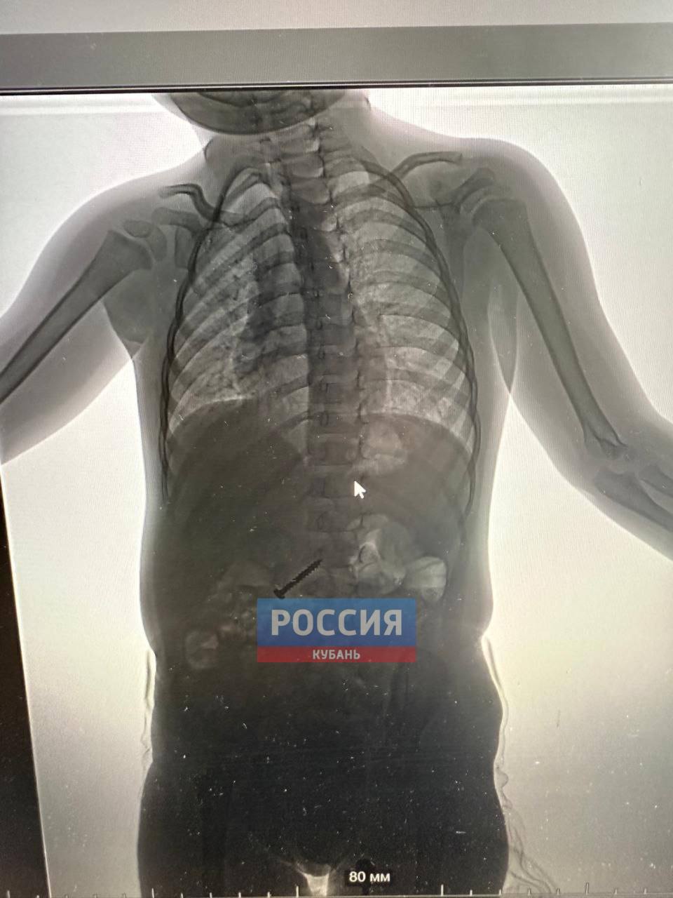2-летняя девочка проглотила саморез в Новороссийске Маленькая девочка играла с братом, но развлечения закончились слезами. Ребёнок проглотил саморез. Медикам нужно было решить сложную задачу. Острый предмет мог проколоть стенку желудка. Врач использовал специальный инструмент, взял саморез за шляпку и вытаскивал его острым концом вниз, чтобы не повредить пищевод. К счастью, всё закончилось хорошо. Быть в курсе Прислать новость