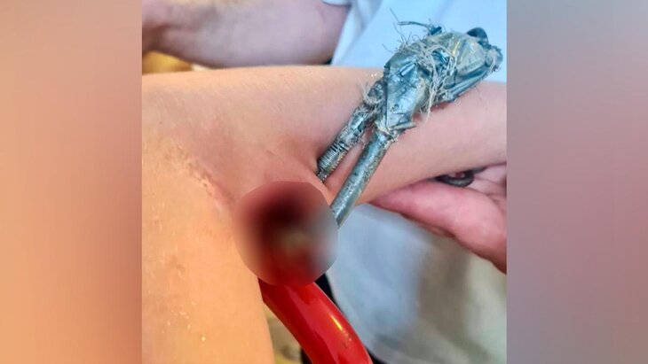 Осторожно, жесткие кадры! В Подмосковье врачи спасли ребёнка, у которого в руке застрял карабин 10-летний мальчик упал с качелей и получил сложную травму — металлический карабин глубоко вошёл в локтевой сгиб при падении. Сотрудники МЧС освободили ребёнка при помощи специнструмента, после чего мальчика доставили в больницу. Травматологи МОЦОМД провели сложную операцию, аккуратно извлекая осколки рядом с нервами и сосудами. Через 4 дня мальчика выписали — функция руки полностью сохранена. Подписаться