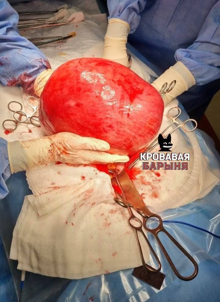 Во Владивостоке врачи удалили миому матки весом 15 кг у 60 летней женщины Во Владивостоке медики Тысякоечной больницы провели сложную операцию 60 летней пациентке у которой диагностировали гигантскую миому матки Женщина несколько лет терпела боли проблемы с мочеиспусканием и отёки но к врачам не обращалась Когда боль стала нестерпимой она вызвала скорую УЗИ показало опухоль размером более 30 недель беременности В ходе экстренной операции осложнённой сдавлением внутренних органов врачи удалили миому весом 15 килограммов как годовалый ребёнок Пациентка успешно восстановилась Это результат многолетнего невнимания к своему организму При своевременном обращении таких осложнений можно было избежать отметил заведующий отделением Медики напомнили о важности регулярных осмотров у гинеколога Подпишись на ПРИМОРЬЕ LIVE