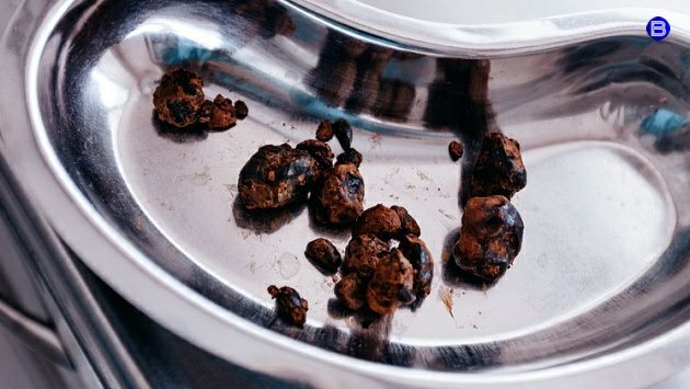 Фабрика камней Новосибирские хирурги удалили 15 крупных камней из желчного пузыря пациента с редкой аномалией: просвет протока у него был 30 миллиметров вместо нормы в четыре раза меньше. Мужчина поступил в областную больницу с подозрением на рак желчного пузыря. Ранее в другом медучреждении ему поставили такой диагноз, потому что он жаловался на желтуху. Но в итоге этот диагноз не подтвердился. Обследование показало, что камни свободно образовывались и росли в увеличенном протоке. Вести Новосибирск