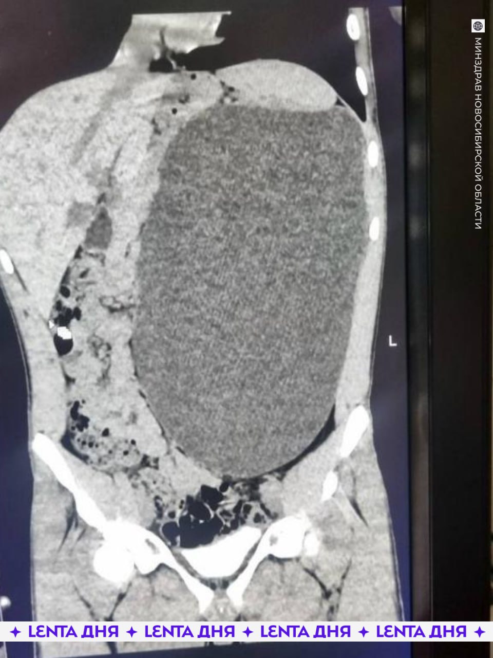 У подростка обнаружили почку размером с пятилитровую бутылку Она занимала почти весь живот и сдавливала остальные органы 17 летний новосибирец не испытывал никаких симптомов и считал себя полностью здоровым Врачи нашли патологию случайно и назвали её бомбой замедленного действия случайный удар по животу мог привести к разрыву этого образования В течение четырёх дней хирурги откачивали скопившуюся жидкость а затем удалили поражённую почку Сейчас пациент идёт на поправку хорошо что всё закончилось благополучно Подпишись на Ленту дня в MAX Участвуй в розыгрыше