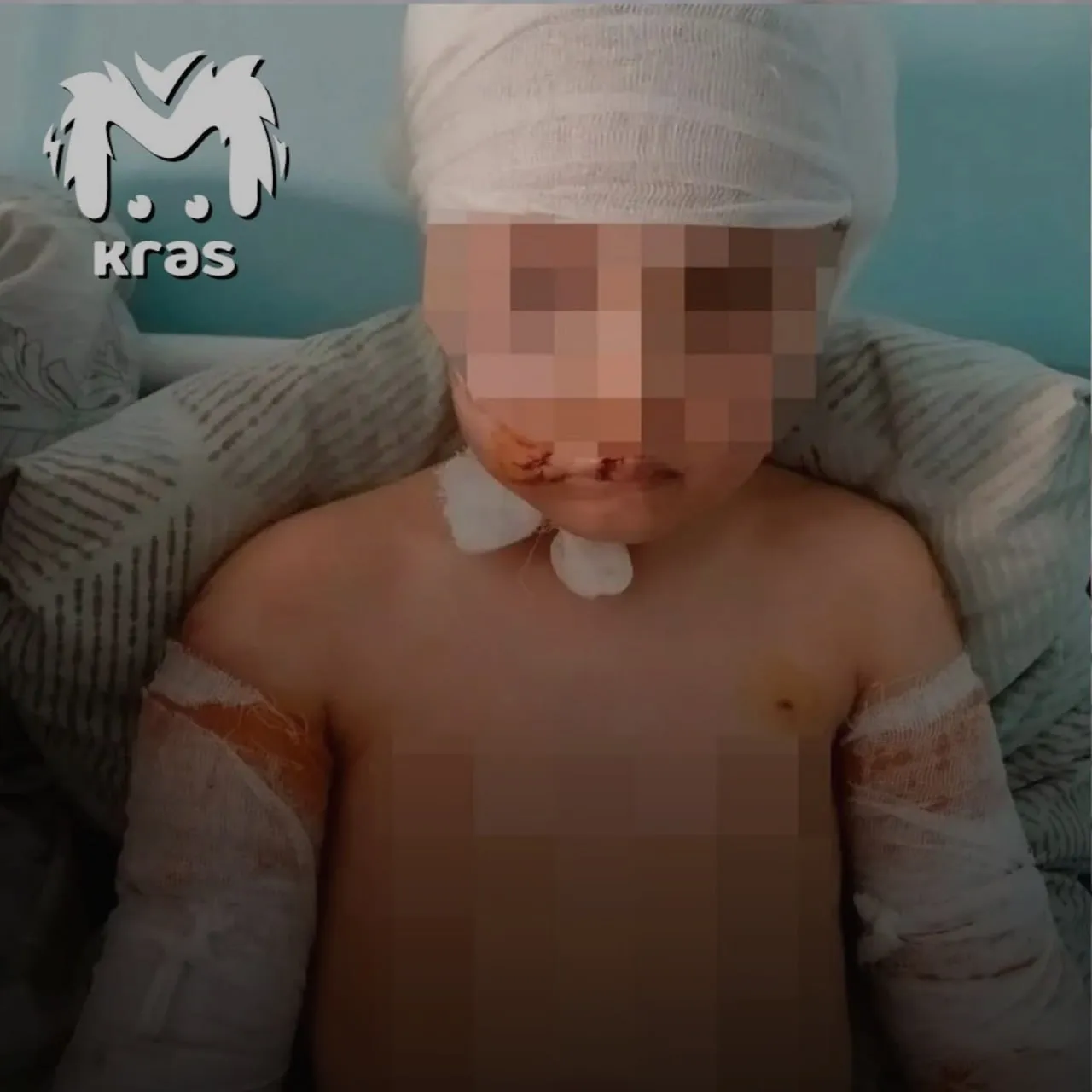 Собаки разодрали пятилетнюю девочку в Красноярском крае Папа привел дочку на детскую площадку а сам отошел в магазин Тогда на малышку набросилась стая бродячих псов Разогнать зверей помог прохожий он же вызвал скорую Ребенка пришлось отправлять в больницу санавиацией У нее множество ран в том числе на голове Но все они неглубокие Местные власти должны были организовать отлов собак еще в 2024 году но ничего не сделали Возбуждено уголовное дело о халатности проблему нужно срочно решать Подписывайтесь на PostNews в MAX