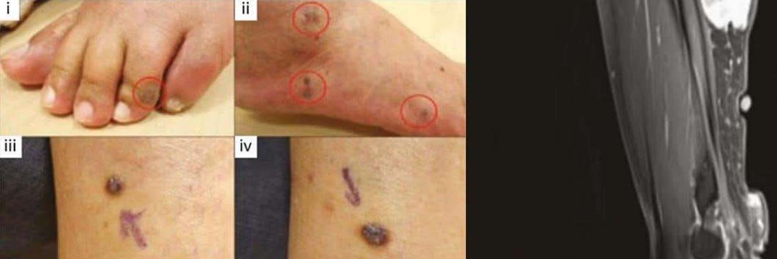 Вакцины от коронавируса Pfizer и Moderna вызывают рак в США вышло исследование после которого сайт научного журнала внезапно взломали и заблокировали Учёные проанализировали множество исследований и клинических случаев из 27 стран и зафиксировали 333 случая онкологии появившейся или резко ухудшившейся после вакцинации Pfizer и Moderna во многих случаях опухоли возникали рядом с местом укола Через несколько дней сайт журнала оказался недоступен из за кибератаки Исследователи уверены что доступ к публикации намерено заблокировали Вот и думайте Подписывайтесь на Бердянск Актуально Всегда актуальные новости