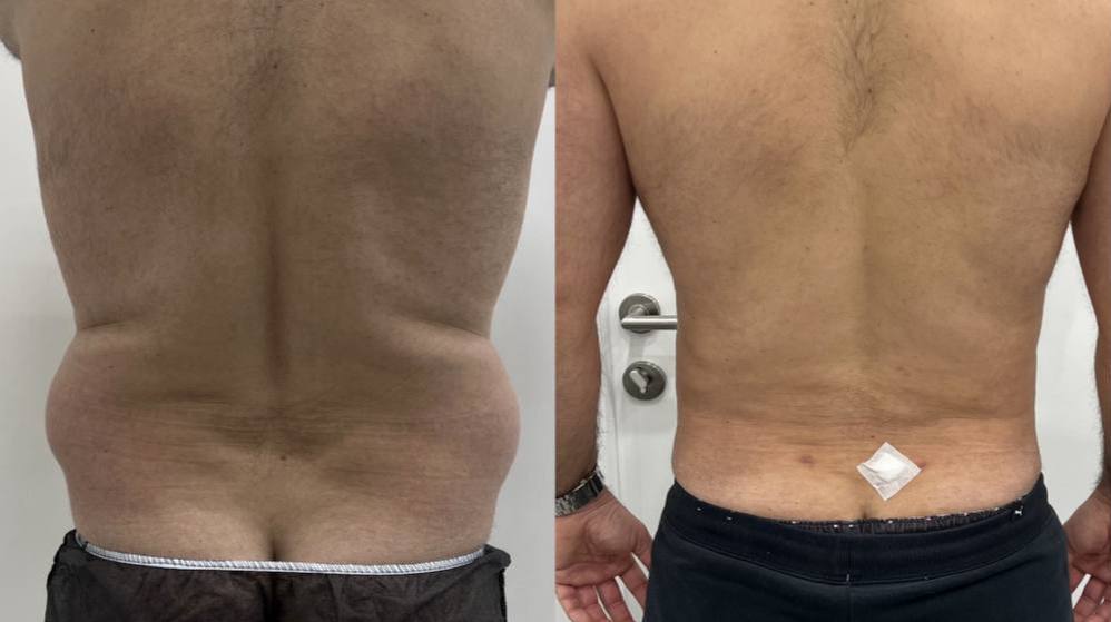 Российские мужчины стали массово делать пластические операции Самые популярные процедуры подтяжка лица рельеф мышц липосакция и подтяжка ягодиц Подписаться Написать нам