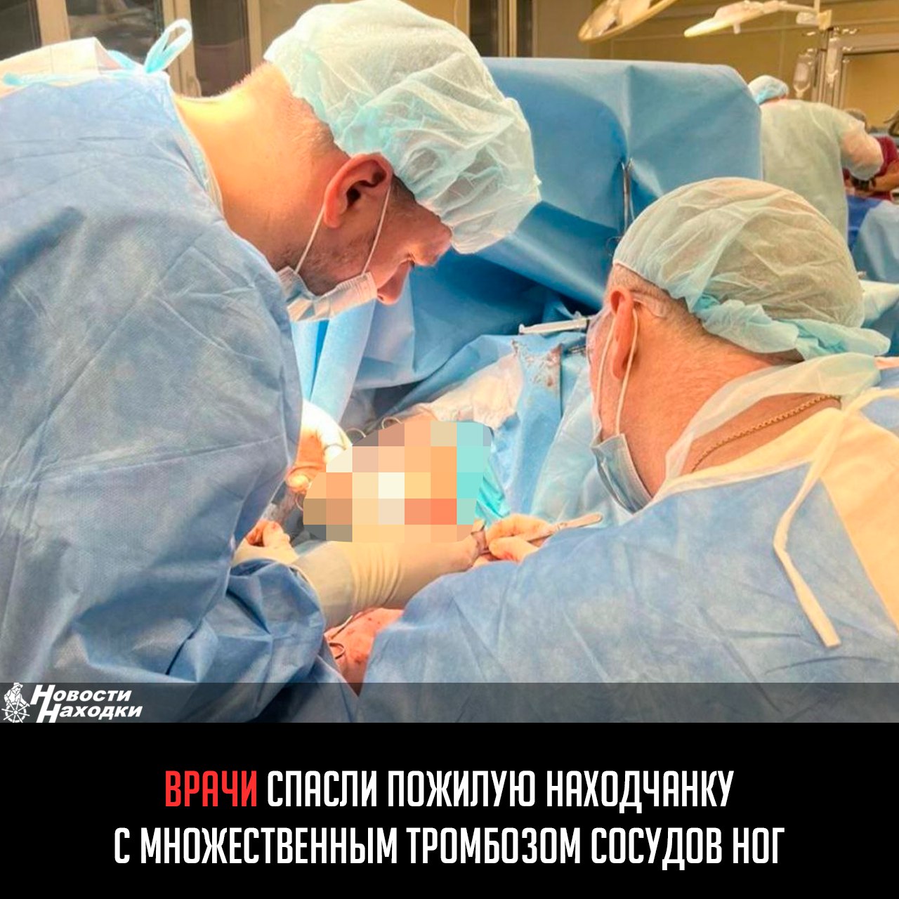В хирургическое отделение Тысячекоечной больницы Владивостока экстренно поступила 70-летняя жительница Находки, испытывавшая мучительные боли в ногах на протяжении двух недель. Обследование выявило множественные тромбы в сосудах обеих конечностей. Нарушение кровообращения могло привести к потере ног, почечной недостаточности, тяжёлой интоксикации и даже смерти. Пациентке в экстренном порядке была проведена сложная операция длительностью 3,5 часа — тромбэктомия, целью которой было полное удаление тромбов и восстановление нормального кровотока. Вмешательство прошло успешно: кровоток полностью восстановлен, угроза тяжёлых последствий устранена. Уже через сутки пациентка отметила улучшение самочувствия. До этого случая она не обращалась к врачам, однако экстренное обследование выявило у неё серьёзное нарушение сердечного ритма, которое и стало причиной образования тромбов. Врачи подчёркивают важность регулярной диспансеризации и своевременного обращения за медицинской помощью.