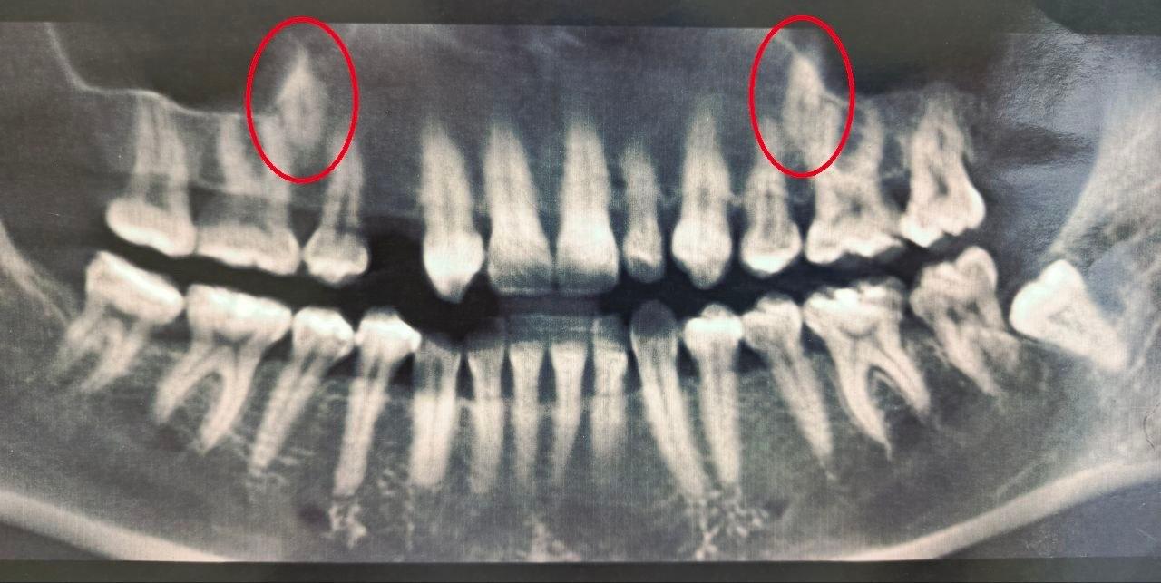 Воронежские стоматологи помогли 38 летней женщине с двумя непрорезавшимися зубами в основном ряду В 2023 году врачи выяснили что один из зубов у женщины полностью отсутствовал а второй был намного меньше нормы Тогда врачи решили вмешаться и переместить непрорезавшиеся зубы в ряд Стоматологи установили пациентке брекеты которые та носила на протяжении полутора лет создавая место для новых зубов После этого врачи хирургически раскрыли коронки непрорезавшихся зубов и зафиксировали ортодонтические кнопки для их вытяжения На данный момент благодаря специальному оборудованию один из зубов полностью вышел из костной ткани а второй успешно прорезается Мы в Max