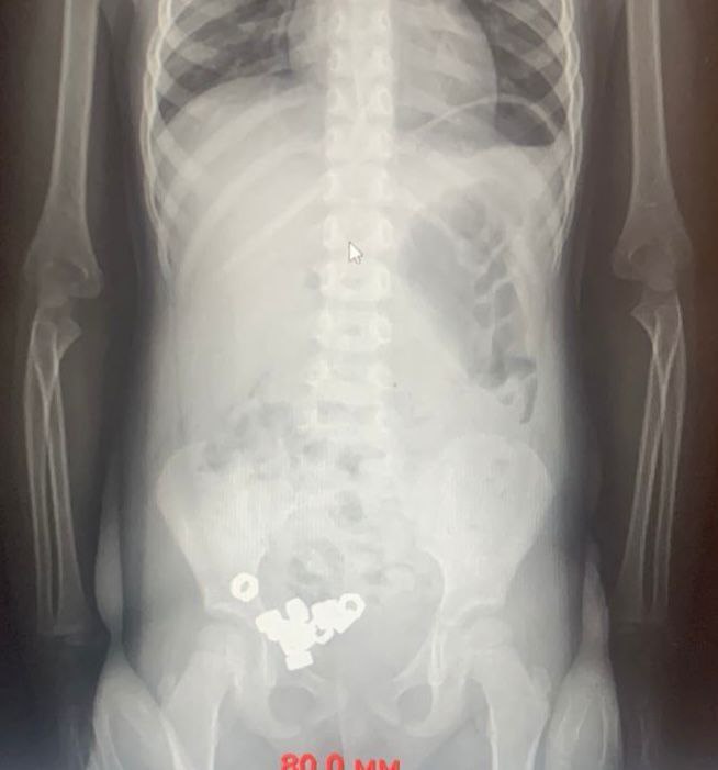 Трехлетка из Воронежа проглотил 16 гаек Родители привезли малыша в больницу на всякий случай им казалось что он мог что то съесть Рентген показал не что то а 16 настоящих гаек аккуратно уложенных в ЖКТ как конфетки При это мальчик совсем не плакал и не жаловался на боль Врачи выбрали спокойную тактику диета контроль и наблюдение На третий день гайки вышли естественным путем а ребенка выписали Малыш отделался легко А вот родителям судя по всему пора убирать инструмент подальше Подпишитесь на Абзац TG VK Дзен MAX Rutube