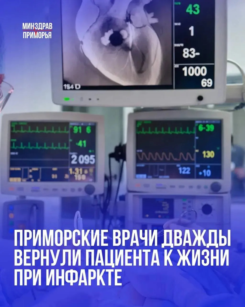 Во Владивостоке пациент пережил несколько остановок сердца и выжил после операции 42 летнего мужчину с острым инфарктом доставили в региональный сосудистый центр Приморской краевой клинической больницы 1 где ему оказали экстренную помощь Как сообщили медики коронарный сосуд был перекрыт тромбом Врачи провели стентирование и восстановили кровоток Во время транспортировки и вмешательства у пациента несколько раз останавливалось сердце однако его удалось запустить и стабилизировать состояние После операции мужчина пришёл в себя и был переведён из реанимации в обычную палату Мы в МАХ vmfareast