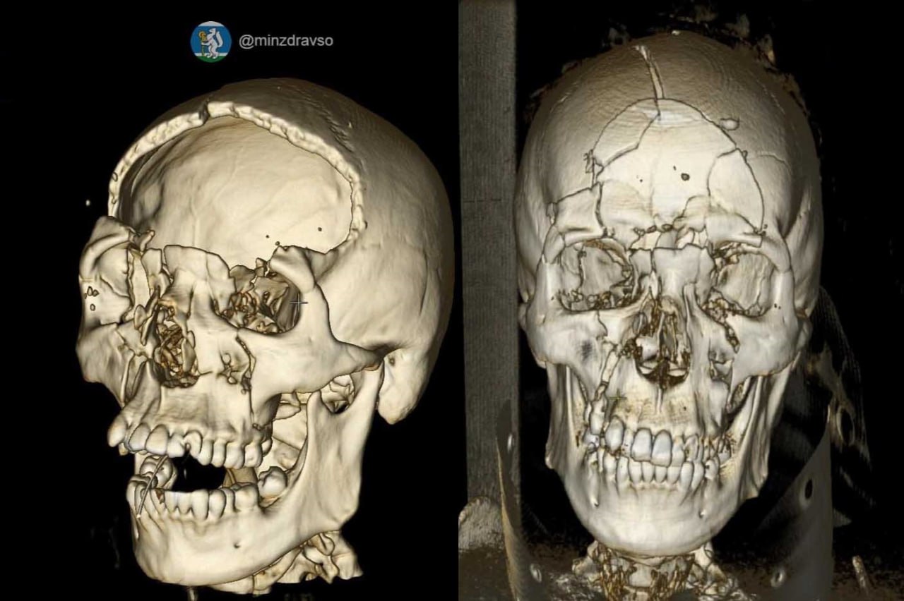 В Нижнем Тагиле врачи спасли 25 летнего парня с раздробленным в ДТП черепом Операция длилась 2 5 часа Молодого человека уже выписали из городской больницы 1 Нейрохирурги применили сложную методику бифронтальную трепанацию при которой обеспечивается расширенный доступ к головному мозгу и минимизируются его повреждения остановили кровотечение ювелирно удалили гематомы объёмом около 50 миллилитров провели герметичную пластику мозговой оболочки Оперативное вмешательство позволило избежать тяжёлых неврологических осложнений сообщили в минздраве региона После сложной операции мужчину ждёт длительная реабилитация по индивидуальной программе консультации специалистов а также реконструктивная операция для восстановления дефекта черепа минздрав региона justmediaru