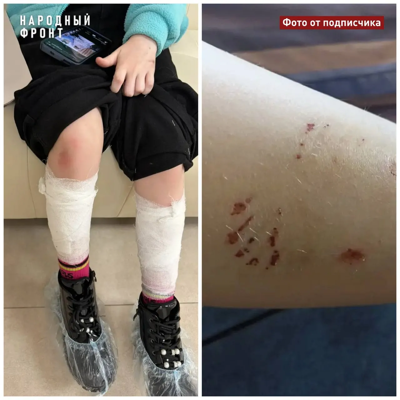 Могла быть прокушена шея в Алейске от укуса бездомной собаки пострадала школьница В конце марта в Алейске на девятилетнюю девочку по дороге из лицея напала собака ЧП произошло на улице Пионерская Бездомное животное изначально в прыжке пыталось укусить за горло но девочка смогла увернуться пострадали ноги ребенка Девочка сейчас проходит лечение в стационаре Родители ребёнка обратились в прокуратуру и подали в суд но последствия для психики так просто не устранить Отметим проблема актуальна для Алтайского края Только в 2025 году на прямую линию президента поступило 190 обращений по ней Виноваты в первую очередь безответственные владельцы а также отсутствие системы контроля численности бродячих животных хотя необходимый закон принят еще два года назад Поэтому Народный фронт совместно с управлением ветеринарии принимают участие в рейдах по проверке маркировки и регистрации собак по местам содержания безхозяйных животных Мы будем контролировать организацию пунктов временного размещения на территории всего края Подписывайтесь НФ НФ в МАХ