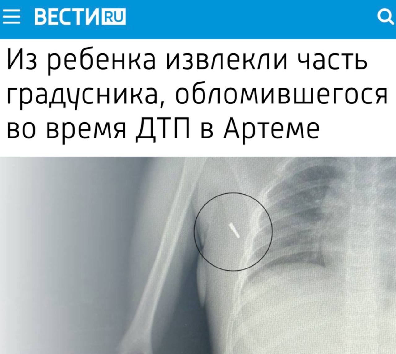 В Артеме из тела восьмилетней девочки была успешно извлечена часть ртутного градусника, который вонзился в нее во время дорожно-транспортного происшествия. Во время поездки ребенку измеряли температуру, и в результате аварии наконечник градусника отломился и попал в подмышечную впадину.  Медицинские специалисты провели операцию по удалению обломка градусника и выполнили контрольный рентген. После нескольких дней лечения в стационаре состояние девочки стабилизировалось, и она была выписана домой. Врачи отметили, что ртуть, попавшая в организм в небольших количествах, не несет серьезной опасности для здоровья.