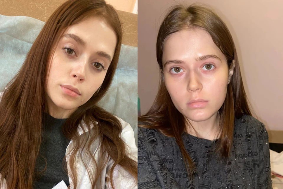 В Новосибирске умерла 23-летняя Татьяна Дроздова с редким генетическим заболеванием АДА-ТКИН, которая судилась с областным Минздравом за импортное лекарство стоимостью 50 миллионов рублей — мать девушки Алена Дроздова/«Комсомольская правда»  Суд обязал новосибирский Минздрав выдать девушке лекарство, это решение устояло после всех обжалований к ноябрю 2024 года, но Татьяна так и не получила свой препарат — «7х7»  По словам Дроздовой, в последние дни ее дочь страдала от головных болей и частично потеряла зрение; девушка просила сделать ей компьютерную томографию, но в больнице сказали, что кабинет КТ закрыт. Предположительно, причиной смерти девушки стал отек мозга.  Татьяна была единственным человеком в России, который дожил с АДА-ТКИН до 23 лет — это заболевание приводит к почти полному отсутствию иммунитета. Врачи рекомендовали назначить ей Revcovi, но областной Минздрав отказывался его закупать, так как его нет в списке жизненно важных препаратов и оно не зарегистрировано в России.