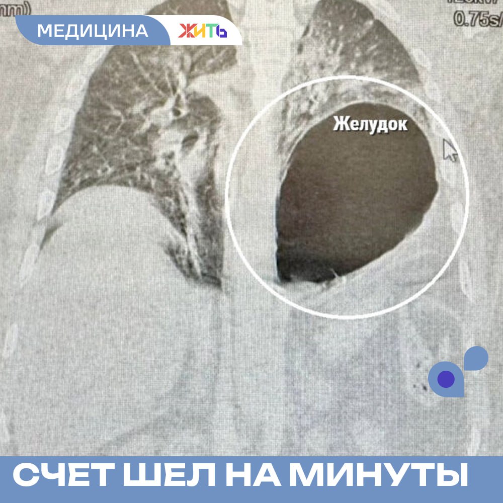 В Подмосковье врачи спасли мужчину, у которого желудок сместил легкое  В Подмосковье врачи Истринской больницы провели экстренную операцию 45-летнему мужчине, у которого после падения с высоты желудок сместился в плевральную полость, сдавив сердце и легкое.  Пациент поступил в больницу в критическом состоянии: он едва мог двигаться и дышать. Диагностика выявила серьезные повреждения – разрыв диафрагмы, множественные переломы ребер и смещение желудка в грудную клетку. Из-за сдавления внутренних органов мужчина испытывал болевой шок, и счет шел на минуты. Врачи немедленно провели операцию: переместили желудок в брюшную полость, устранили дефект диафрагмы и восстановили работу легкого.  Благодаря профессионализму медиков и оперативному вмешательству мужчина быстро пошел на поправку.     Самый добрый проект страны