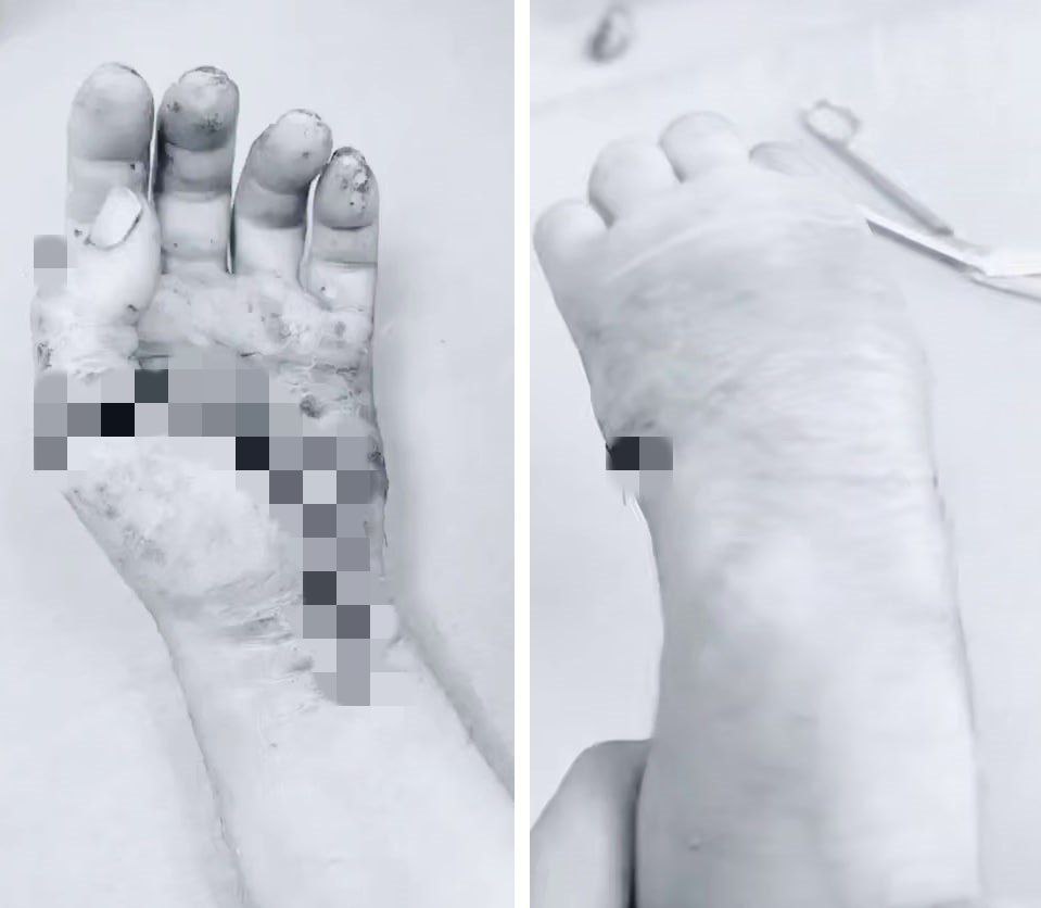 В Пятигорске врачи пришили пациенту отпиленную кисть Диск пилорамы практически отрезал кисть руки 45 летнему мужчине Медики городской клинической больницы проводили операцию почти 4 часа Хирурги кропотливо сшивали мышцы соединяли нервы и сосуды Травматолог ортопед Исмаил Ахмедов рассказал что пациенту повезло рана была ровная а организм оказался крепким Мужчине предстоит реабилитация однако он уже может двигать пальцами сообщается в телеграм канале медучреждения Подписаться на 1777 в Телеграм MAX