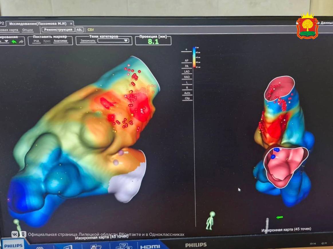Липецкие кардиохирурги благодаря новому оборудованию спасли женщину, которая страдала от приступов тахикардии 11 лет.   Навигационную систему в ЛОКБ купили за счёт облбюджета. Теперь врачи видят мельчайшие сосуды сердца в 3D и могут точнее и быстрее найти очаг заболевания. Установку врачи будут использовать при сложнейших аритмиях и помогать пациентам даже с пересаженным      С лета в больнице сделали уже 69 радиочастотных и криоаблаций — малоинвазивных вмешательств, которые навсегда избавляют от неровных сердечных ритмов.  ↙ На фото: «Красная шапочка» и золотые руки липецкой аритмологии Антон Андреев.