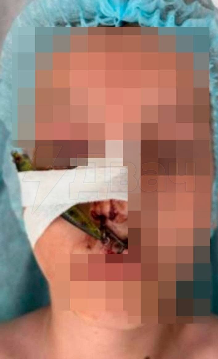 Школьник пошёл ловить леща, но поймал только самого себя  В Подмосковье 10-летний мальчик попал в больницу с разорванным лицом. Паренёк пошёл на рыбалку, взял воблер с крючками в качестве снасти, хорошенько замахнулся, но не рассчитал замах и зацепил себя крючком за лицо.  Ему разодрало губу, нос, а также верхнее и нижнее веки. К счастью, воблер не задел глазное яблоко.  Врачи извлекли снасть, и теперь здоровью неудачливого рыбака ничего не угрожает.